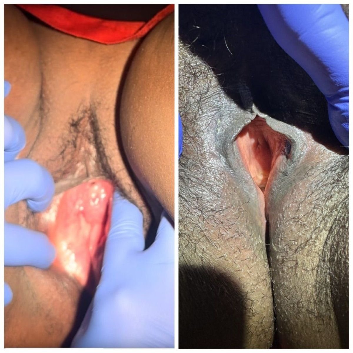 نتائج قبل وبعد تجديد المهبل بالليزر في عيادة Esra Özbaşlı OBGYN