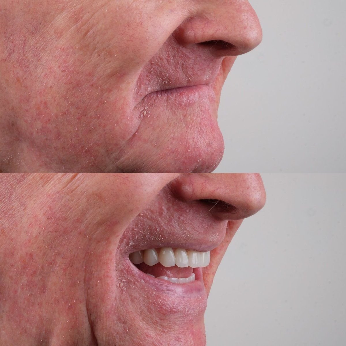 نتيجة قبل وبعد زراعة الأسنان All-on-4 في About Tooth Dental Clinic، ابتسامة محسنة