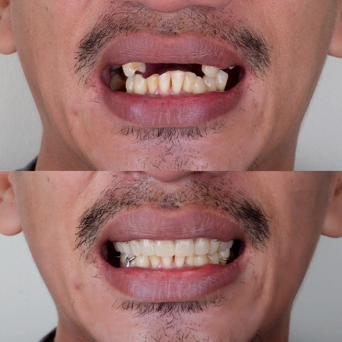 نتيجة قبل وبعد زراعة الأسنان All-on-4 في About Tooth Dental Clinic، ابتسامة محسنة
