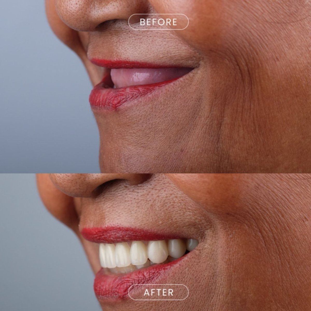 Before and after All-on-4 dental implants result at About Tooth Dental Clinic, smile restoration