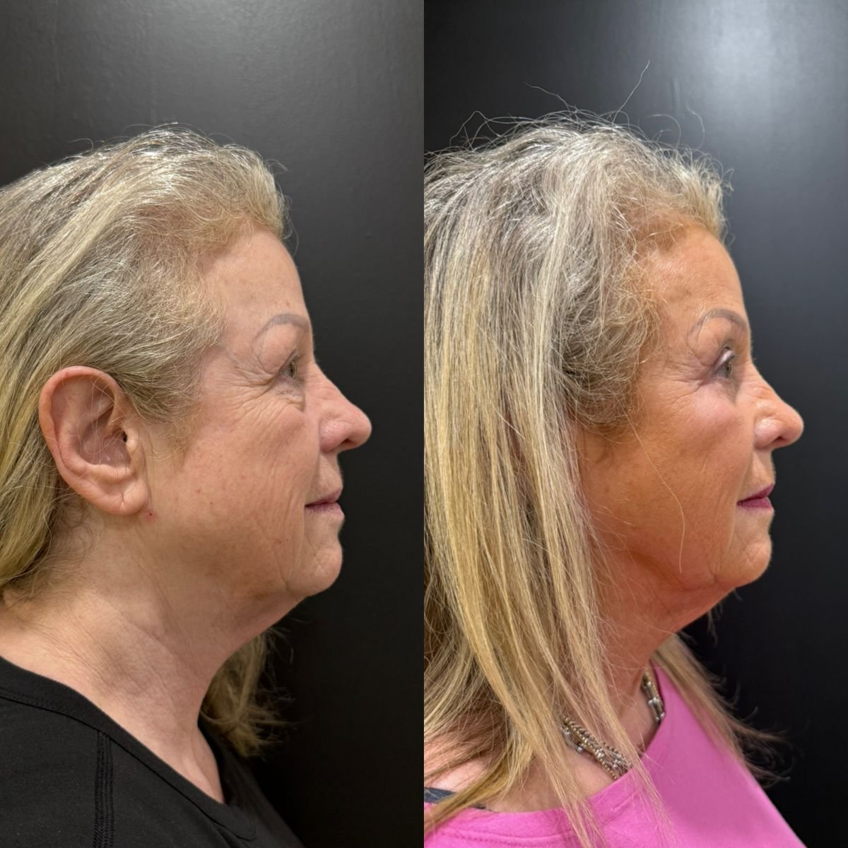 نتائج عملية شد الجفن العلوي قبل وبعد في عيادة Dr. Alexandro Aguilera - Plastic Surgery
