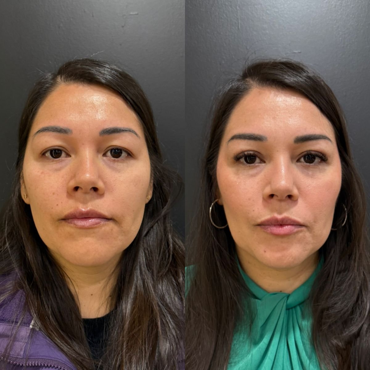 نتائج عملية الجفن العلوي قبل وبعد في عيادة Dr. Alexandro Aguilera - Plastic Surgery