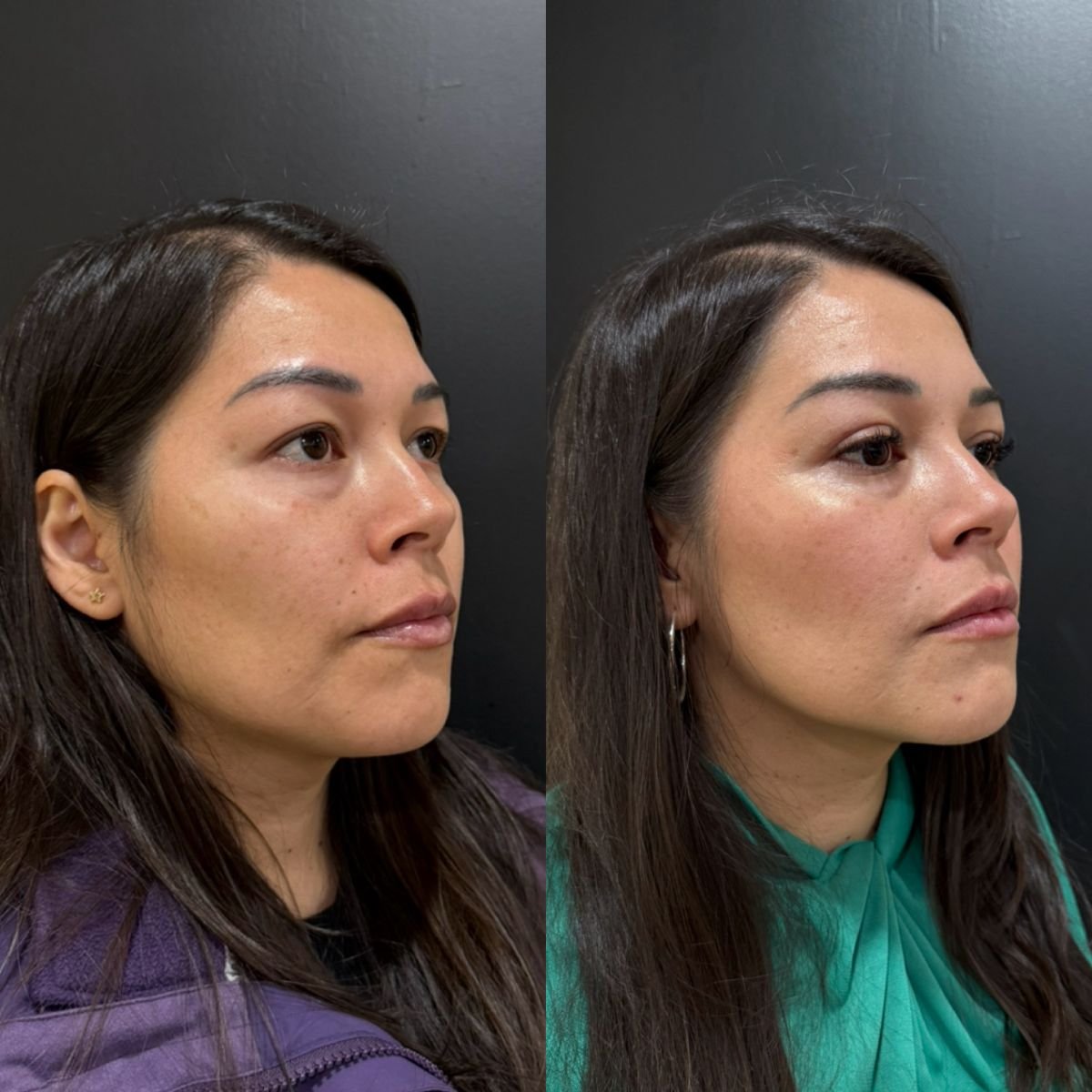 Resultados de blefaroplastia superior antes y después en Dr. Alexandro Aguilera - Plastic Surgery