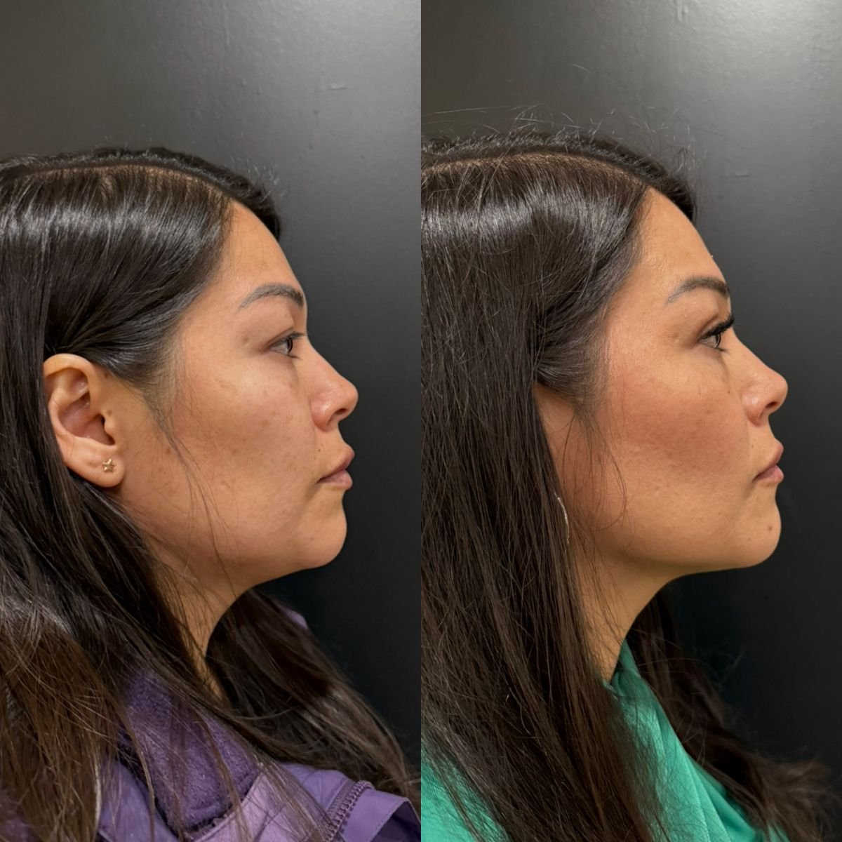 نتائج جراحة الجفن العلوي قبل وبعد في عيادة Dr. Alexandro Aguilera - Plastic Surgery