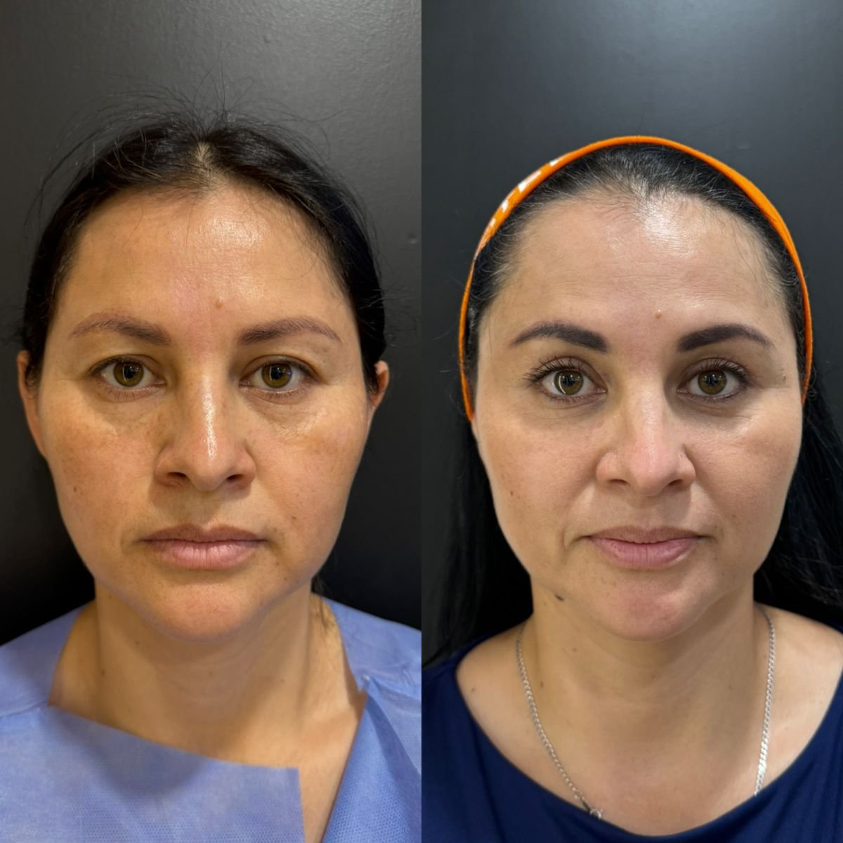 Resultados de blefaroplastia superior antes y después en Dr. Alexandro Aguilera - Plastic Surgery