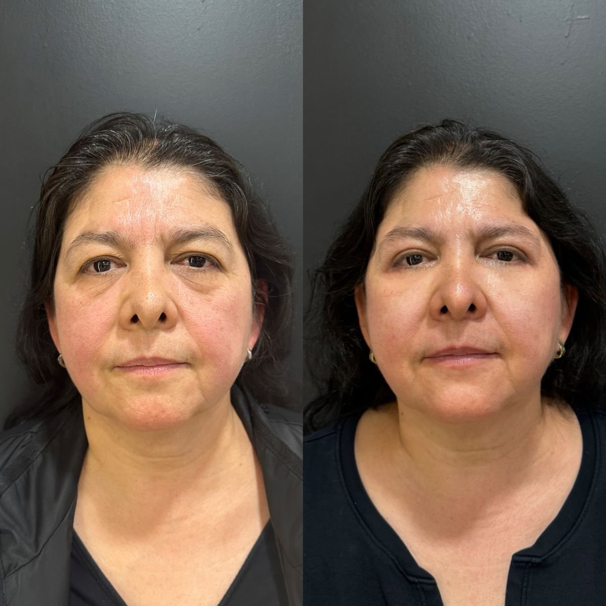 نتائج جراحة الجفن العلوي قبل وبعد في عيادة Dr. Alexandro Aguilera - Plastic Surgery