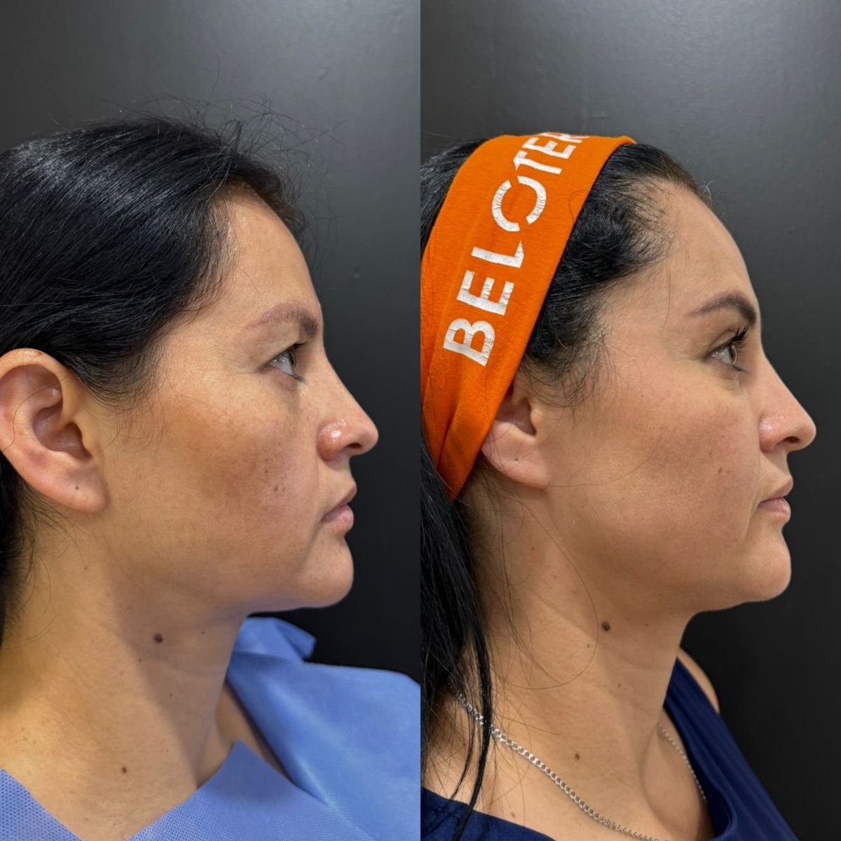 نتائج شد الجفن العلوي قبل وبعد في عيادة Dr. Alexandro Aguilera - Plastic Surgery