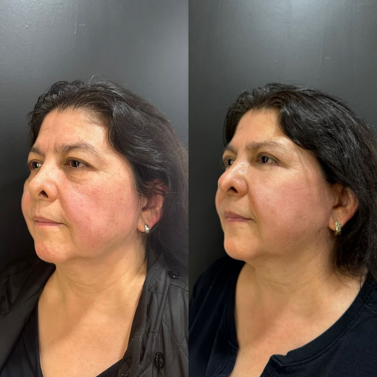 نتائج جراحة الجفن العلوي قبل وبعد في عيادة Dr. Alexandro Aguilera - Plastic Surgery