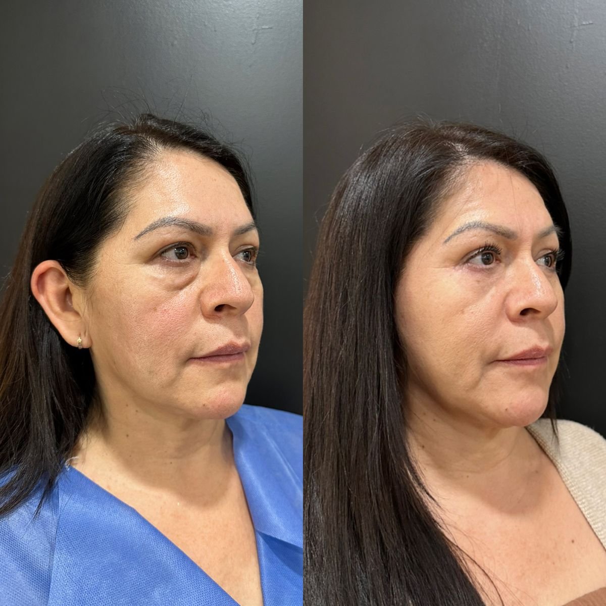 Vorher-nachher-Ergebnis der Oberlidstraffung bei Dr. Alexandro Aguilera - Plastic Surgery