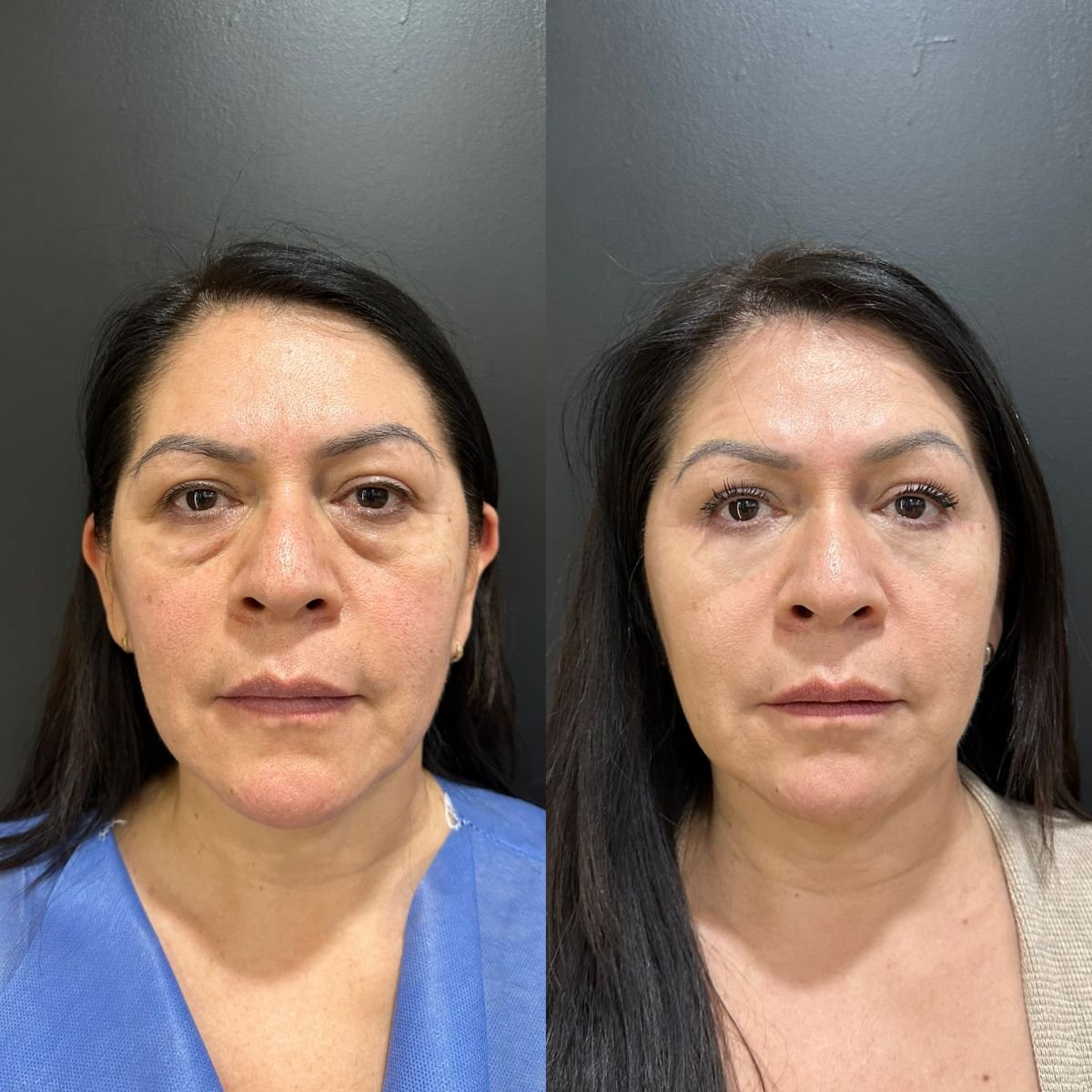 Before and after upper eyelid surgery results at Dr. Alexandro Aguilera - Plastic Surgery clinic