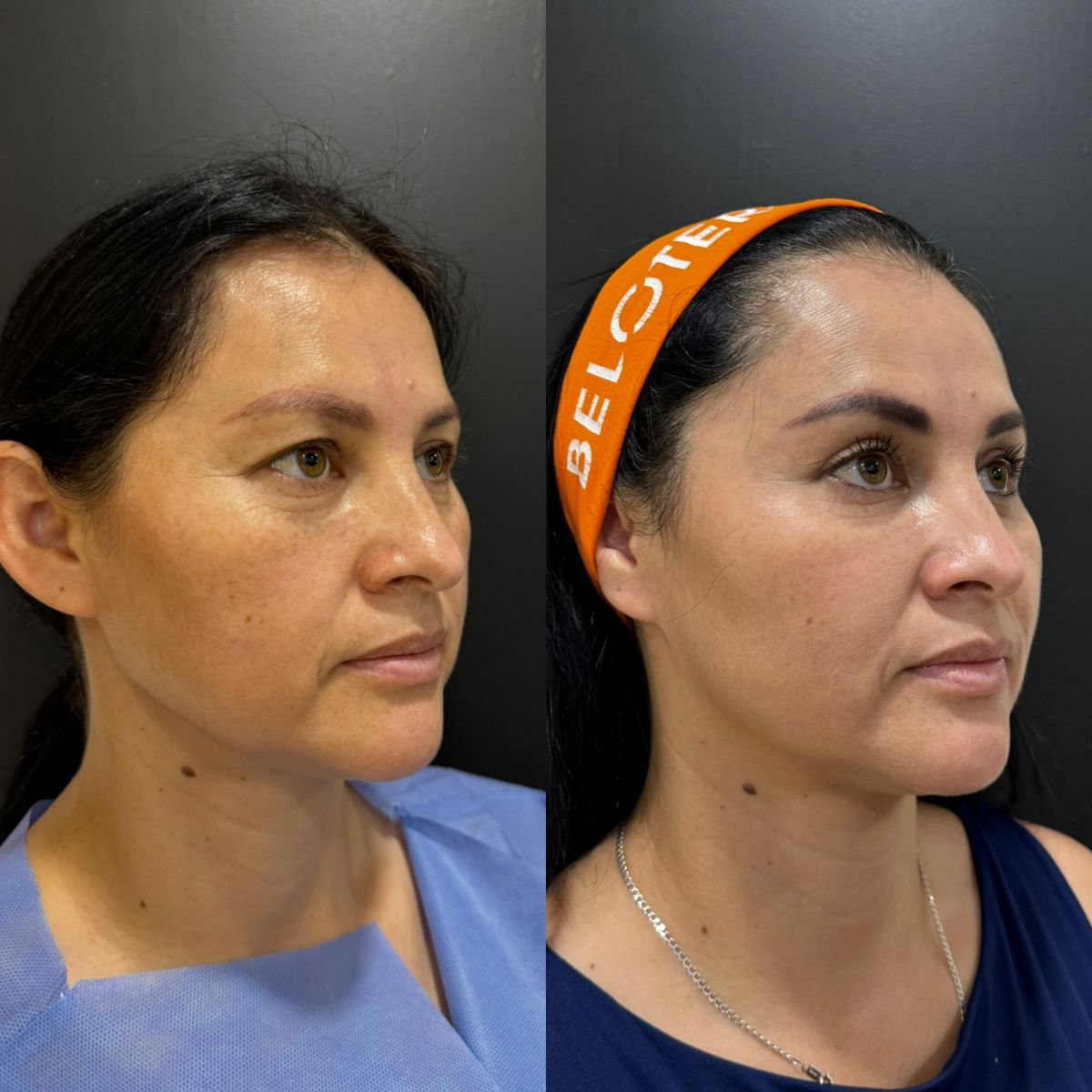 Facelift before and after results at Dr. Alexandro Aguilera - Plastic Surgery, facial rejuvenation