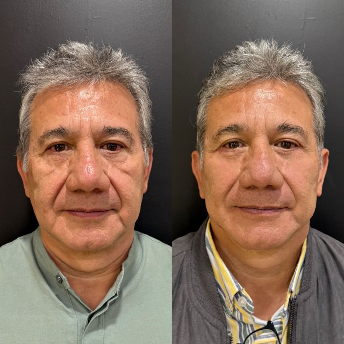 Facelift before and after results at Dr. Alexandro Aguilera - Plastic Surgery, facial rejuvenation