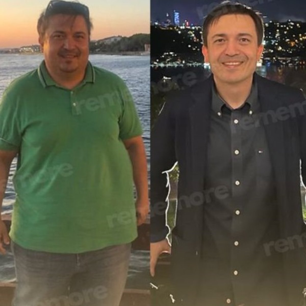 قبل وبعد جراحة التمثيل الغذائي في مستشفى ميموريال غوزتيبي – فقدان وزن ملحوظ