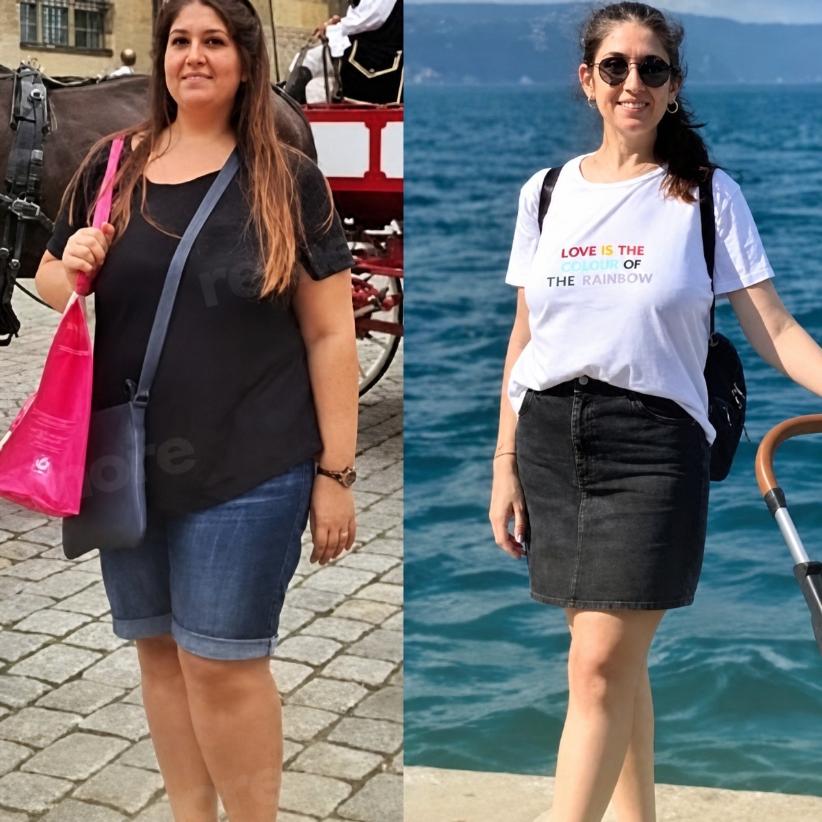 Before and after metabolic surgery at Memorial Göztepe Hospital, visible weight loss result