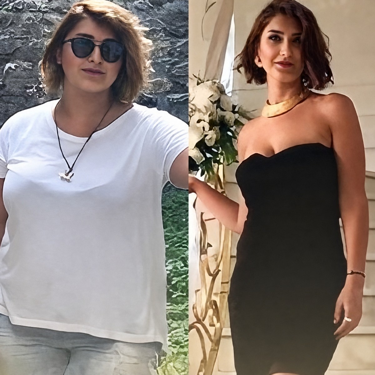 Before and after metabolic surgery at Memorial Göztepe Hospital, visible weight loss result