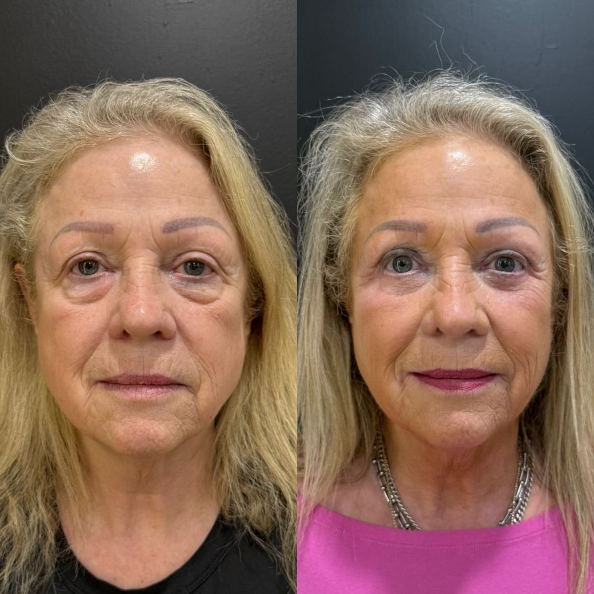 نتائج شد الجفن العلوي قبل وبعد في عيادة Dr. Alexandro Aguilera - Plastic Surgery