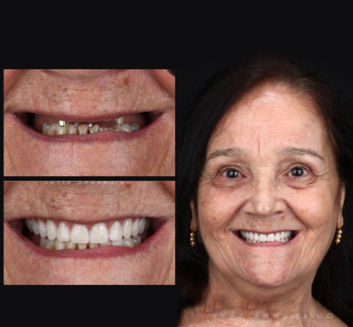 Résultat avant/après implants All-on-4 chez European Valley Health – restauration du sourire
