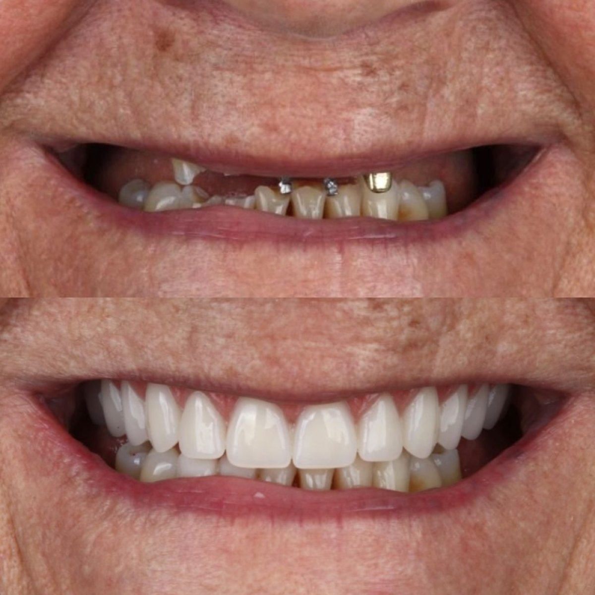 Before and after All-on-4 dental implants result at European Valley Health, smile restoration