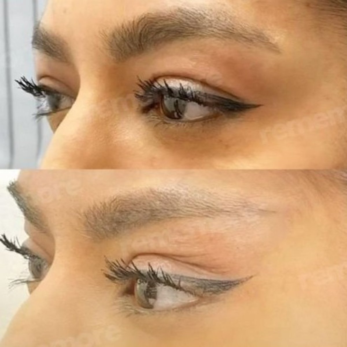 Fox eye lift before and after results at Memorial Şişli Hospital, visible eyelid lift effect
