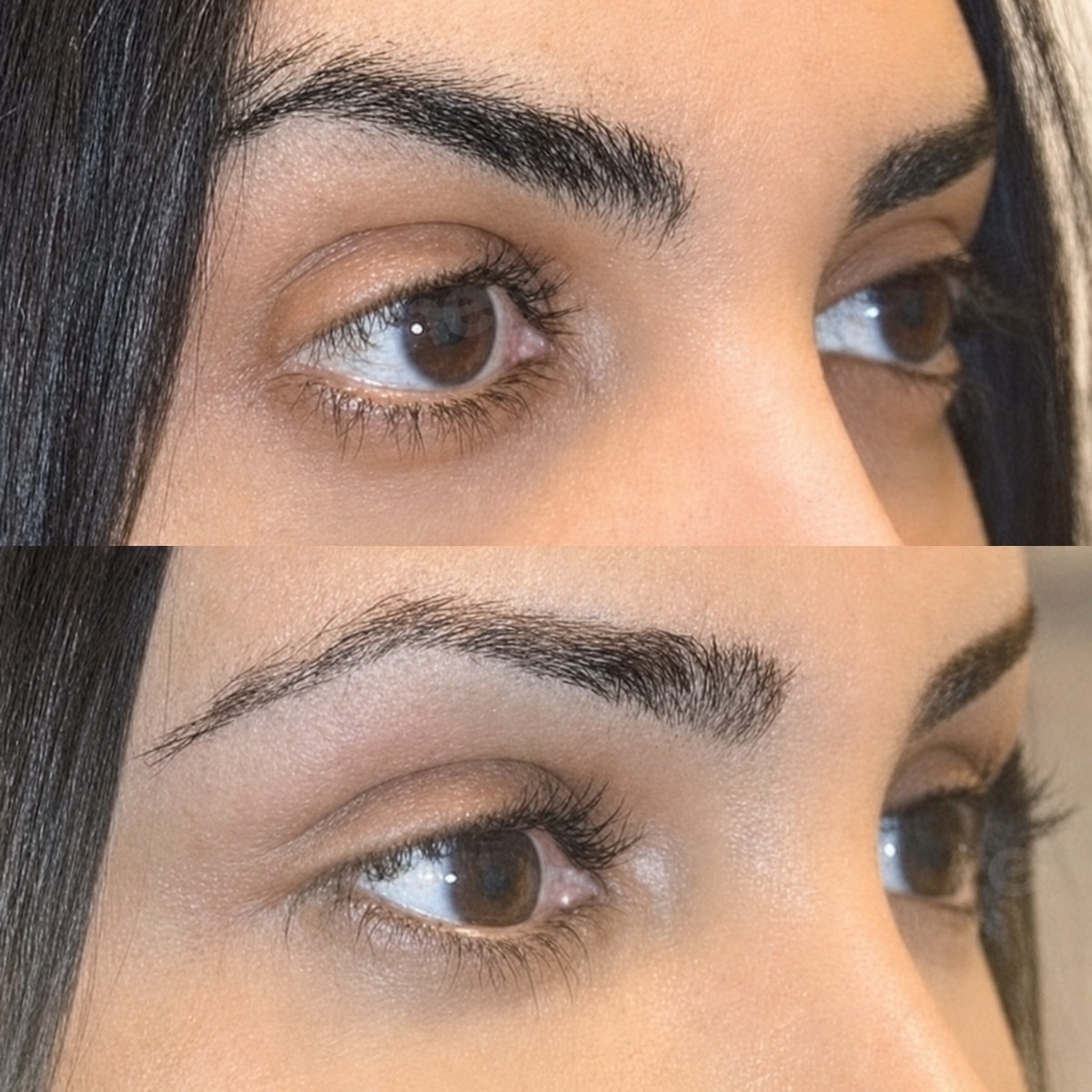 Before and after Fox Eye Lift results at Memorial Şişli Hospital, lifted eyelid appearance