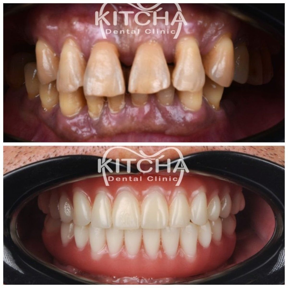 Before and after dental crown replacement results at Kitcha Dental Clinic, improved smile