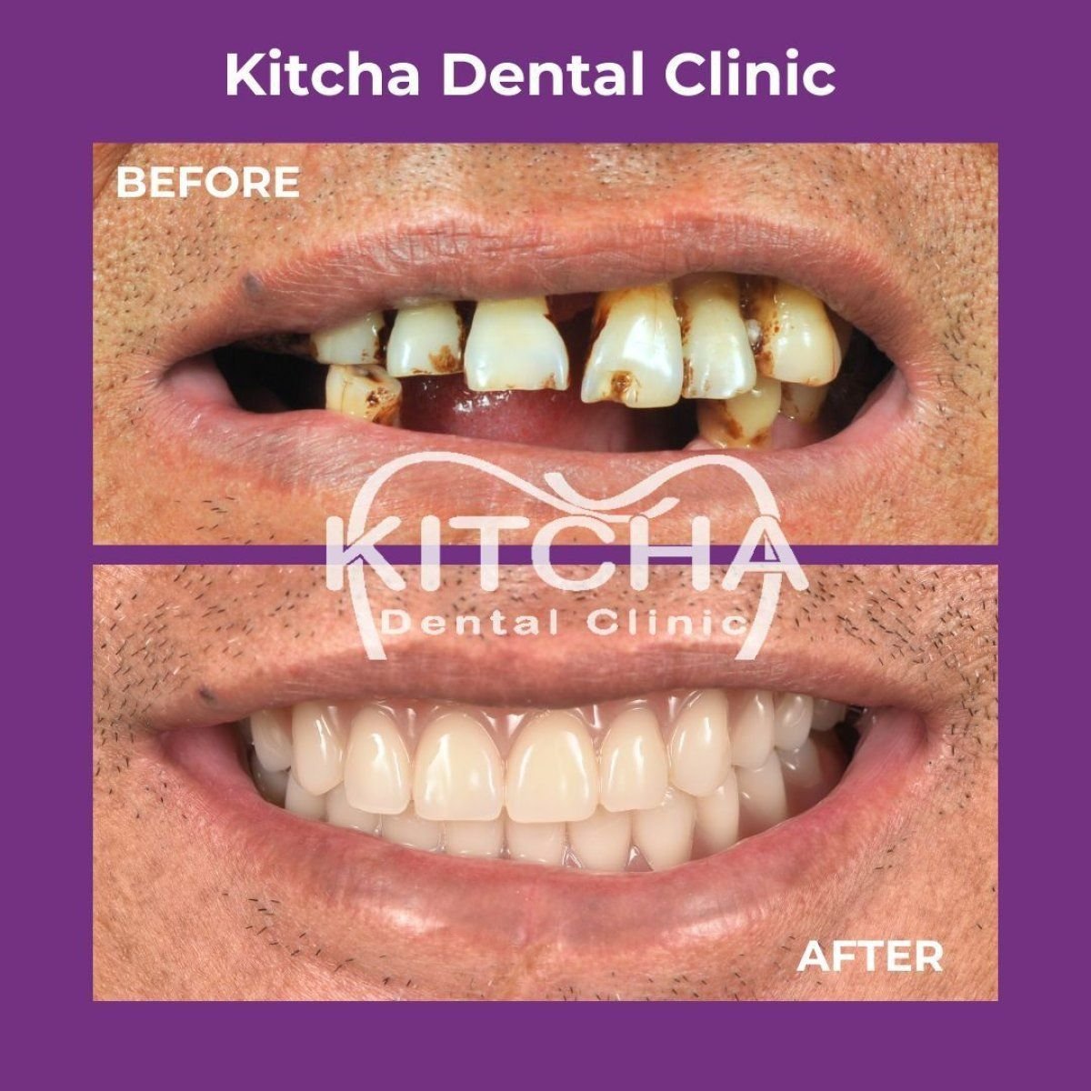Before and after dental crown replacement results at Kitcha Dental Clinic, restored smile