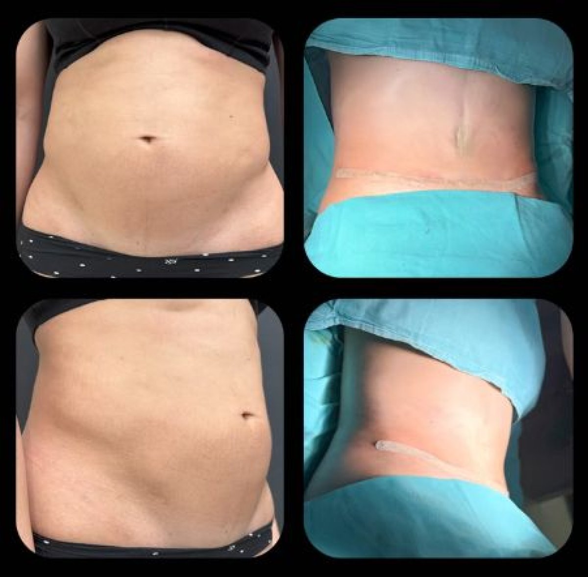 Résultats avant et après abdominoplastie et liposuccion à VM Medical Park Florya Hospital