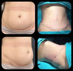 Tummy Tuck + Liposuction for Restored Silhouette — Full Board Included - photo 4