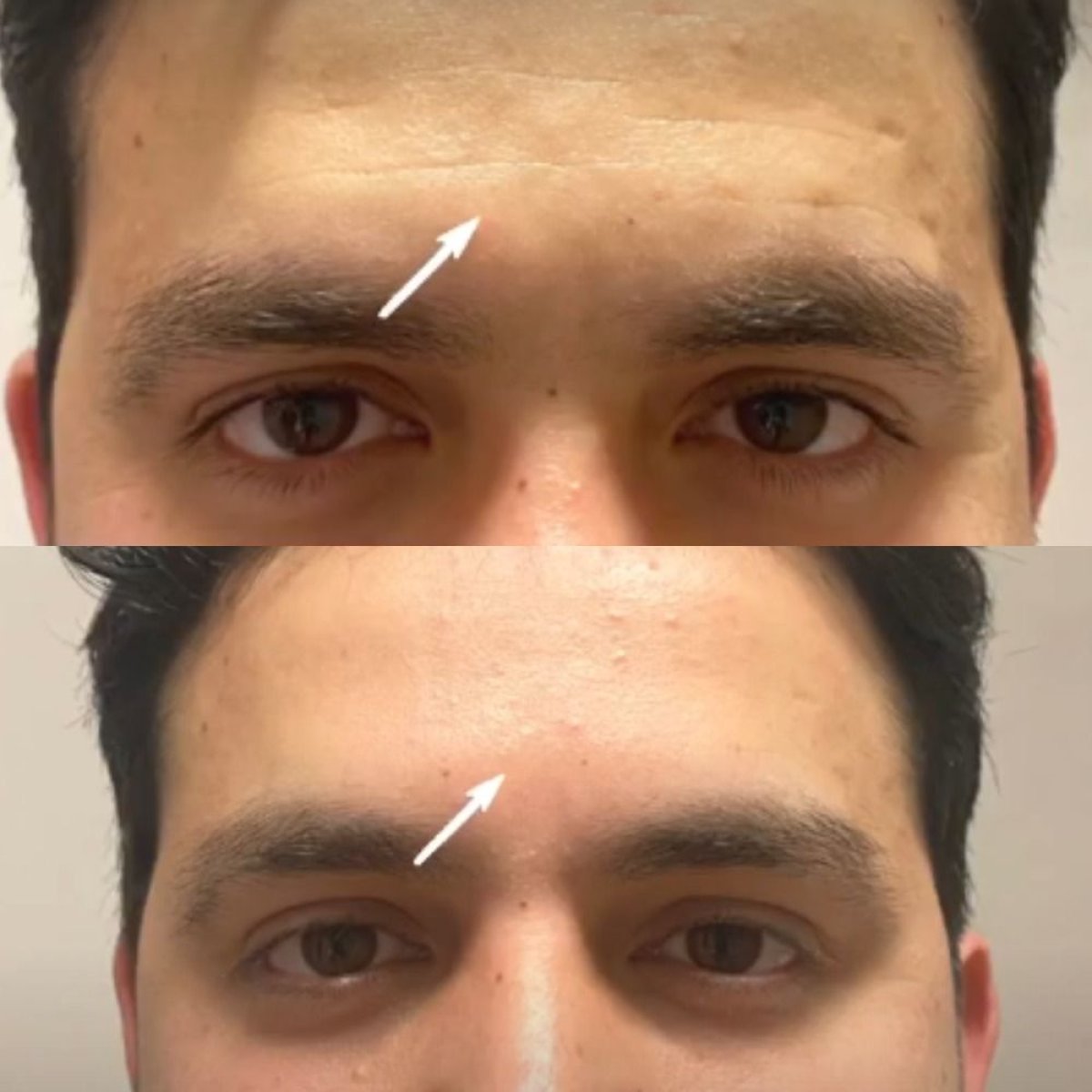 Before and after fillers injection at Quartz Hospital, forehead wrinkle reduction result