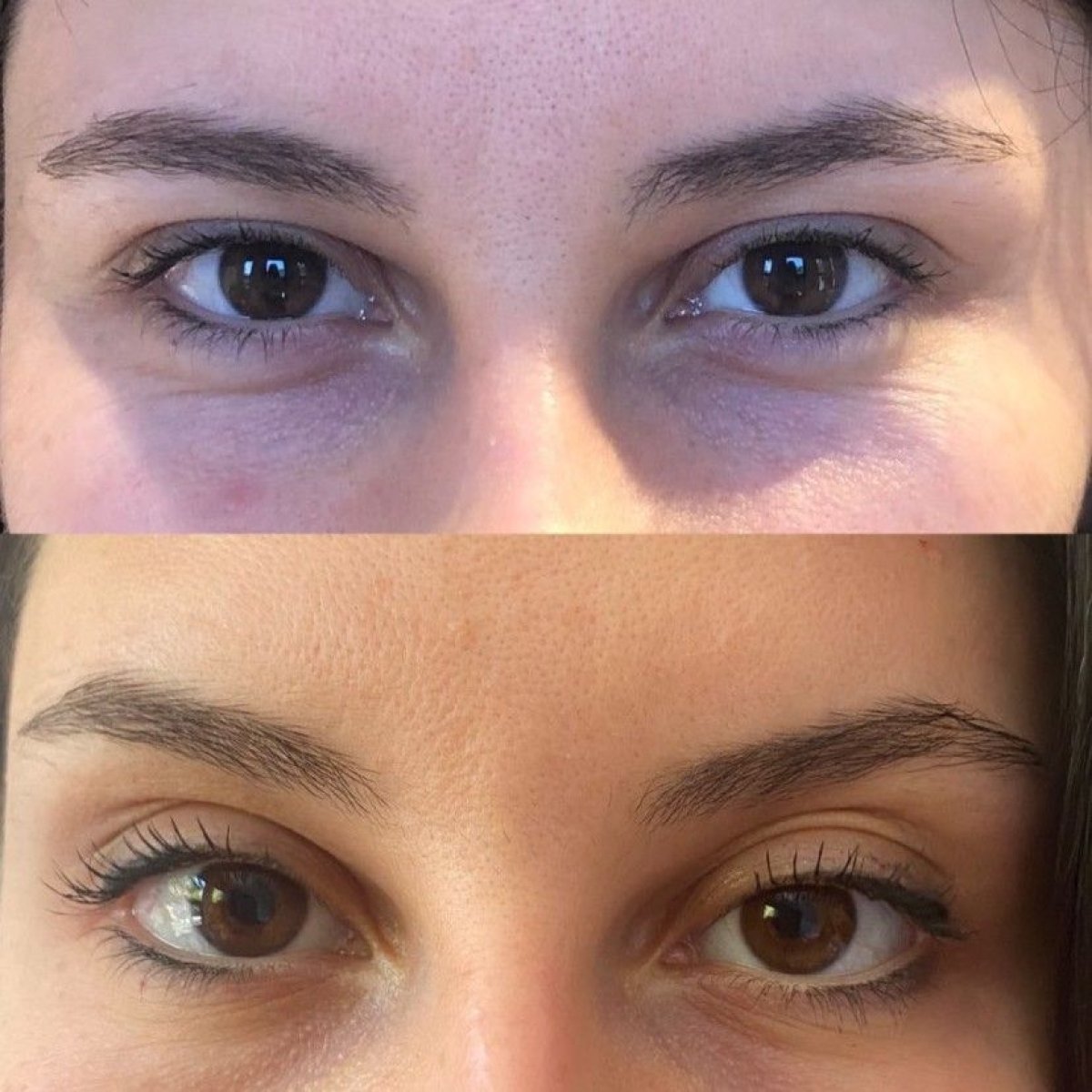 Résultats avant/après injections de fillers sous les yeux à Quartz Hospital