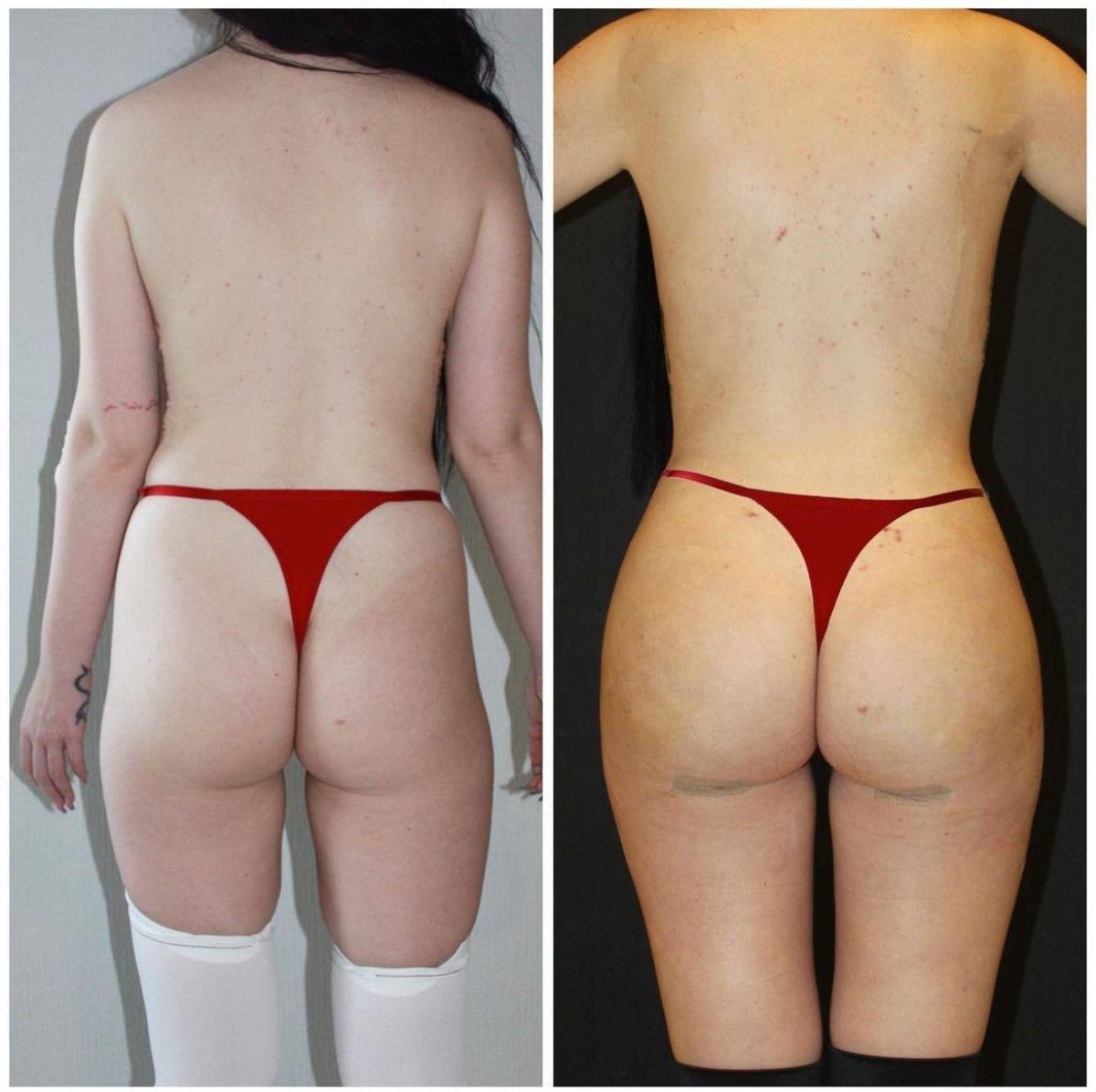 Brazilian Butt Lift before and after results at Dr. Ilker Manavbasi's Clinic, enhanced curves