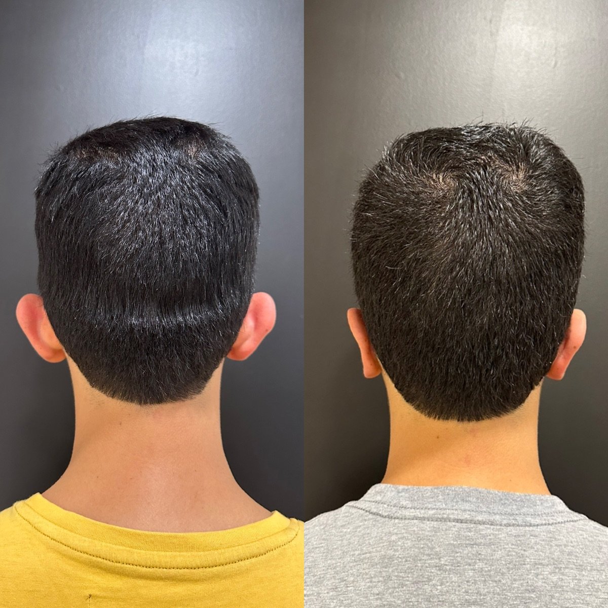 نتائج عملية تجميل الأذن قبل وبعد في عيادة Dr. Alexandro Aguilera - تصحيح الأذن