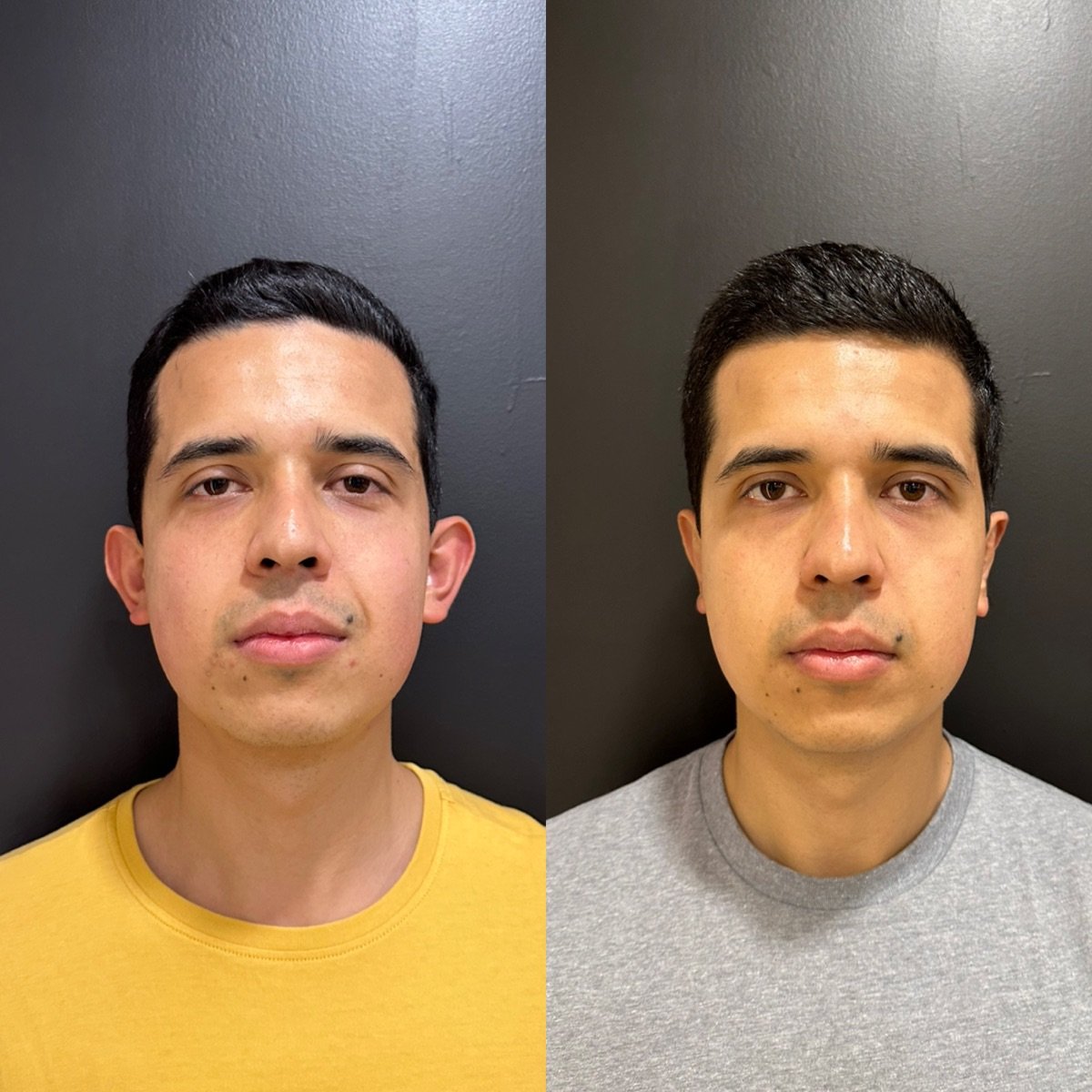 Before and after otoplasty results at Dr. Alexandro Aguilera - Plastic Surgery, ear correction