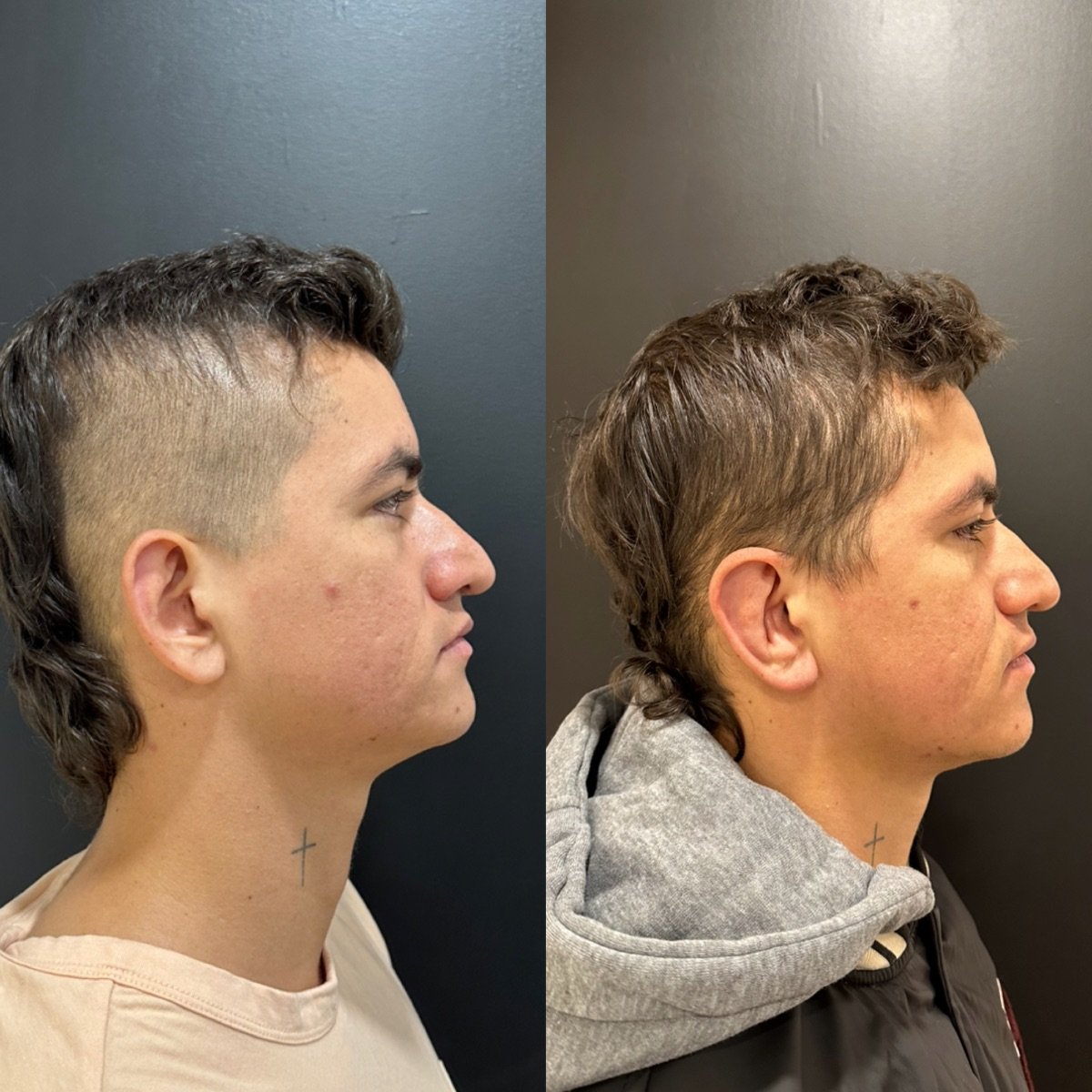 Résultats avant/après otoplastie chez Dr. Alexandro Aguilera - Plastic Surgery, correction des oreilles