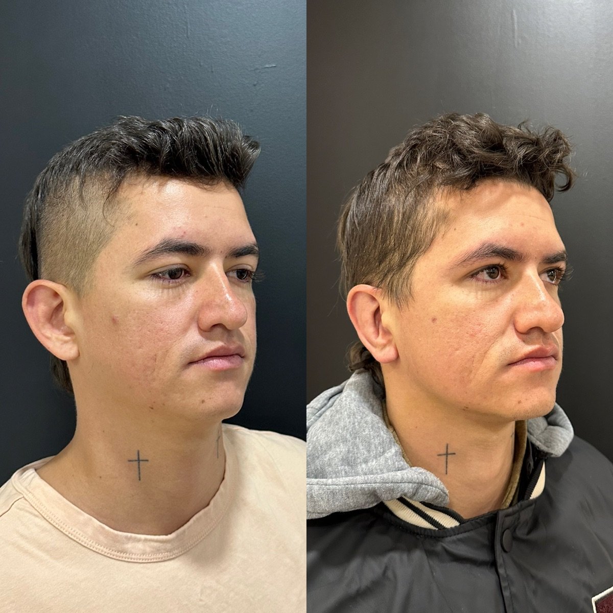 Résultats avant/après otoplastie chez Dr. Alexandro Aguilera - Plastic Surgery, correction des oreilles