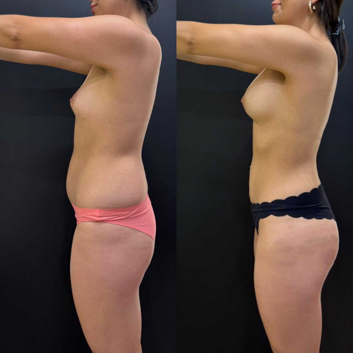 Результаты липосакции до и после в Dr. Alexandro Aguilera - Plastic Surgery, коррекция фигуры
