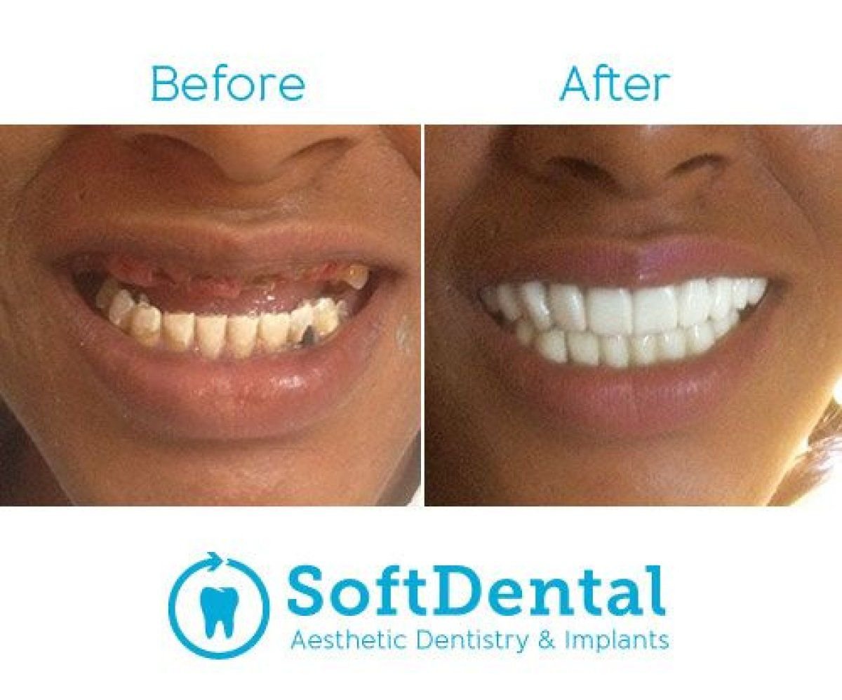Résultat avant/après implants All-on-4 à SoftDentalCare Clinic, restauration du sourire
