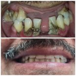 Before and after All-on-4 Dental Implants photos by Dr. 