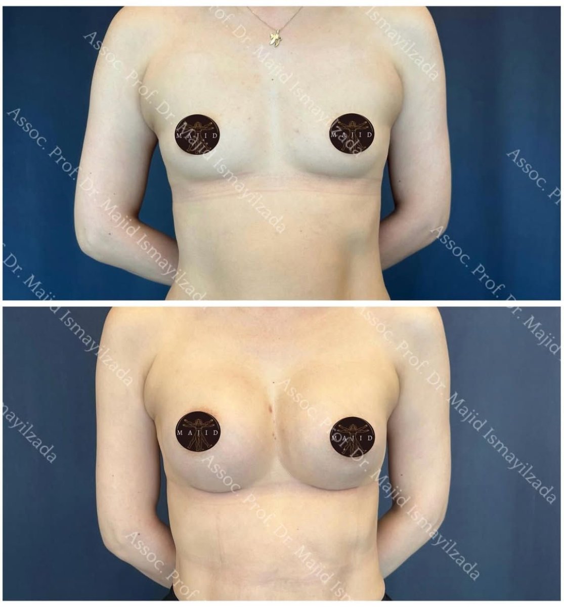 Before and after breast augmentation results at Liv Hospital Vadistanbul, enhanced breast shape