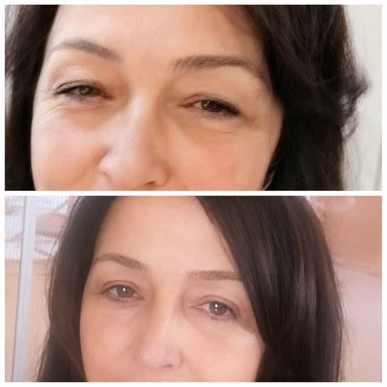 Résultats avant et après blépharoplastie à la clinique privée du Prof. Dr. Ahmet Satici