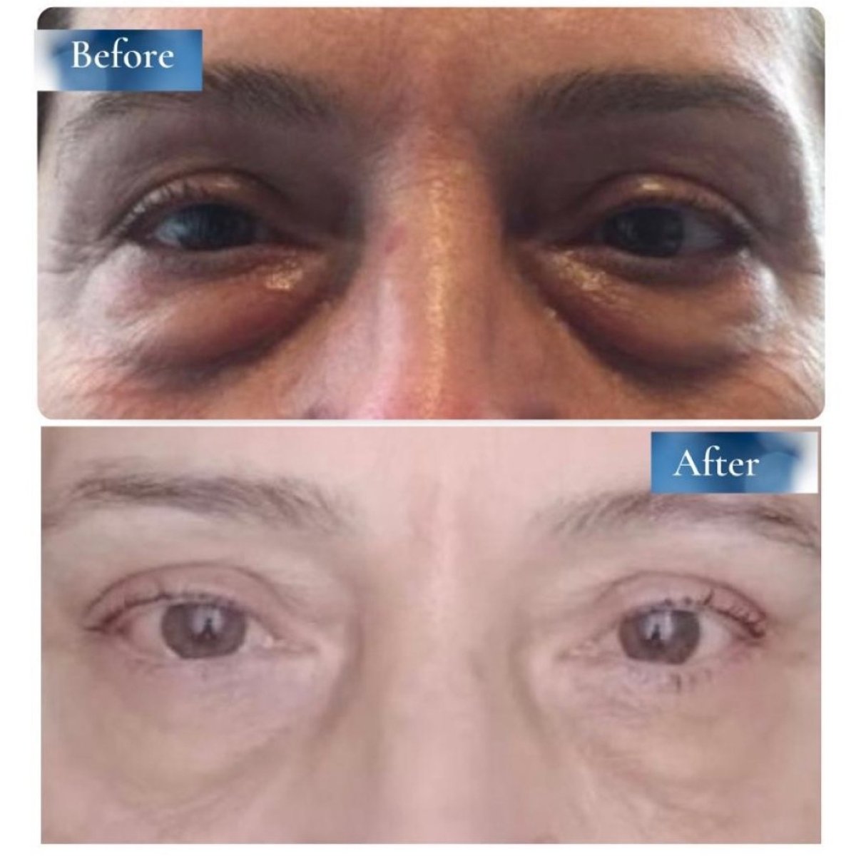 Resultados de blefaroplastia antes y después en Prof. Dr. Ahmet Satici's Private Practice, corrección de párpados
