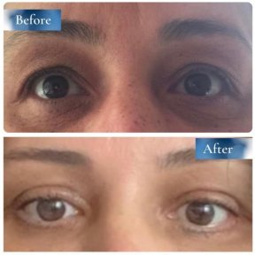 Blepharoplasty by Surgeon with 25,000+ Procedures Performed — Daily Remote Recovery Monitoring - photo 4