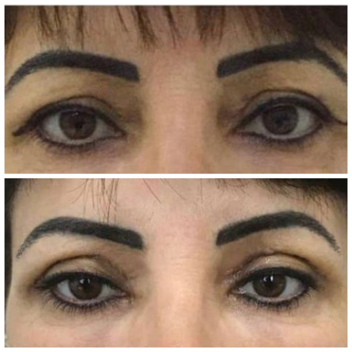 Résultats avant/après blépharoplastie chez Prof. Dr. Ahmet Satici, lifting des paupières