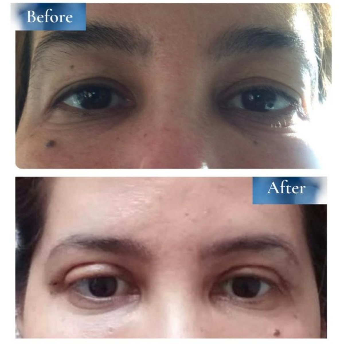 Resultados de blefaroplastia antes y después en la clínica privada del Dr. Ahmet Satici