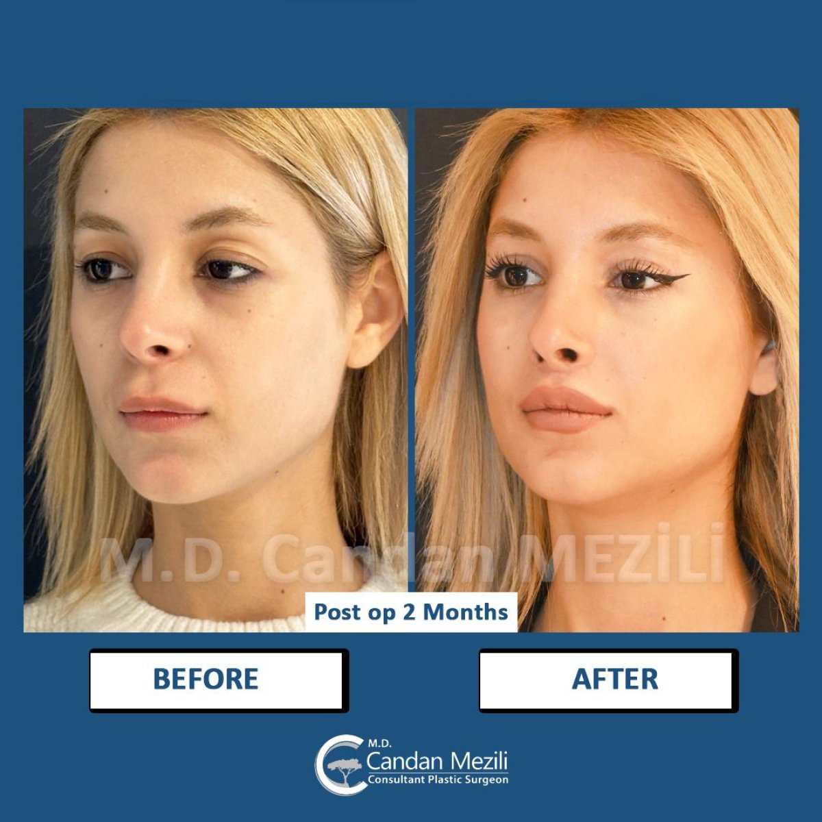 نتائج شد العيون (Fox Eye Lift) قبل وبعد في عيادة د. جاندان ميزلي بعد شهرين