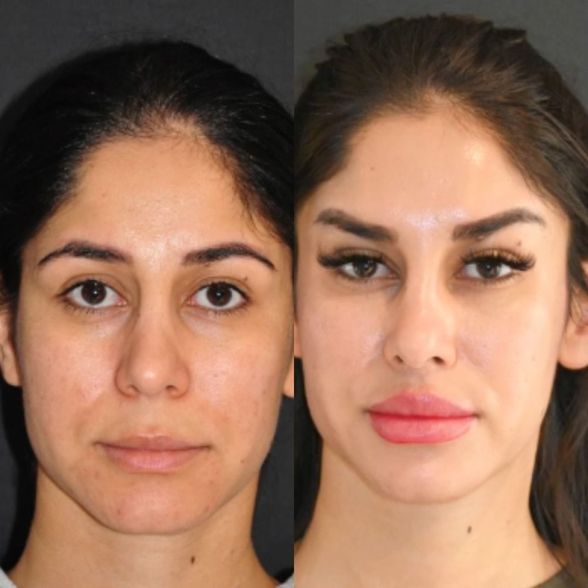 نتائج قبل وبعد Fox Eye Lift في عيادة Dr. Candan Mezili، تأثير رفع الجفن