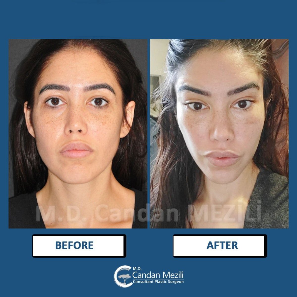 Fox Eye Lift before and after results at Dr. Candan Mezili's Private Practice, lifted eye contour