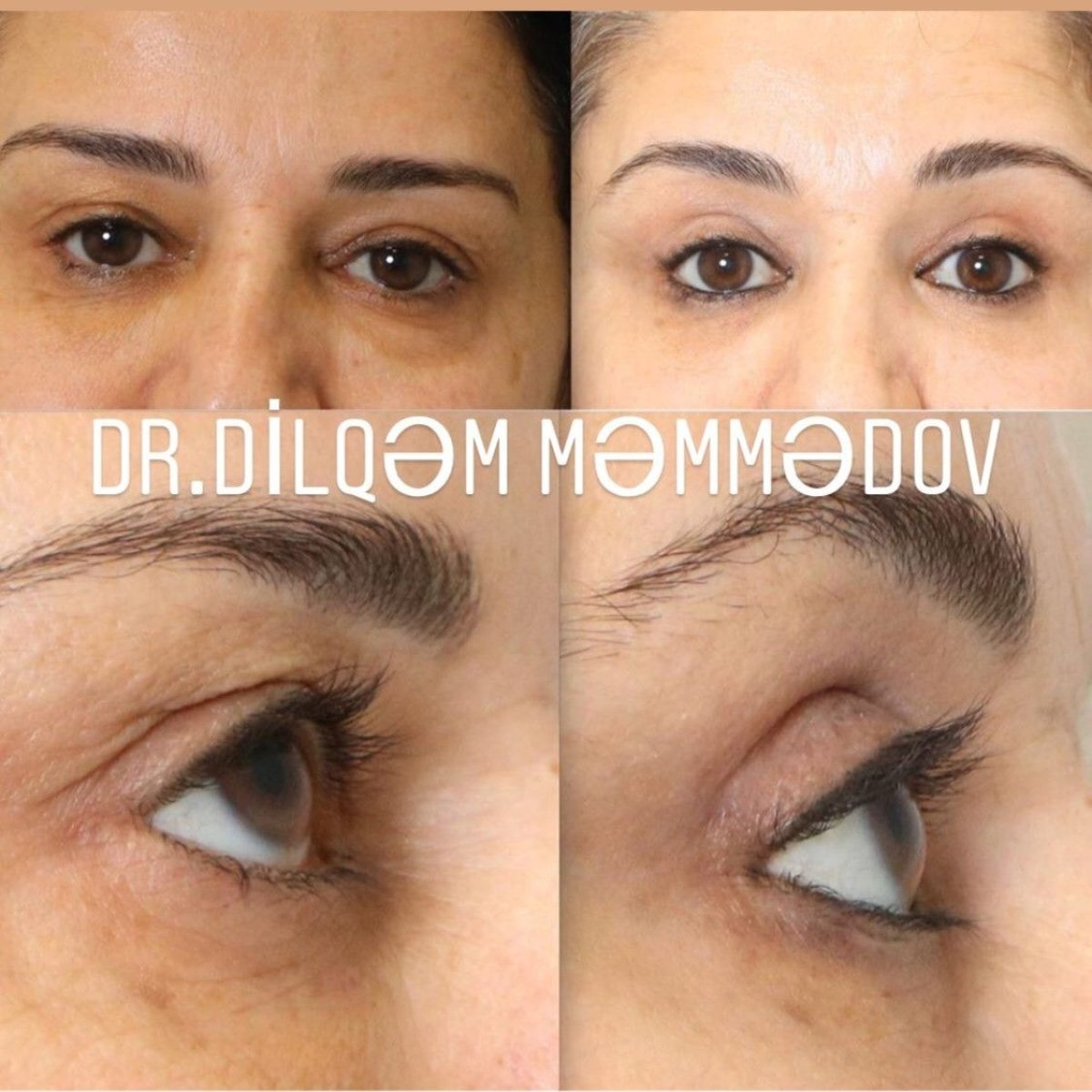Blepharoplasty before and after results at Liv Bona Dea Hospital Baku, eyelid correction