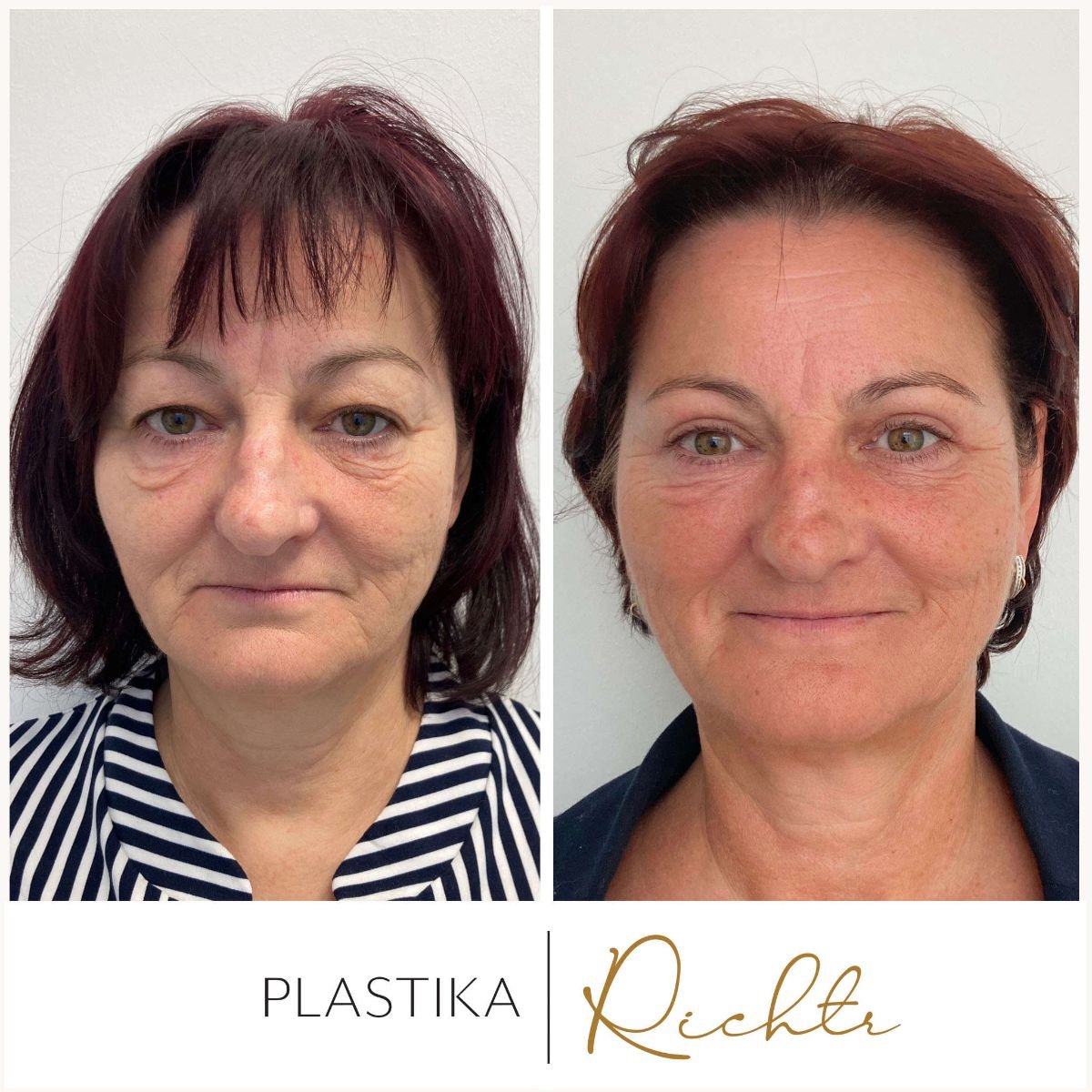 Before and after blepharoplasty results at Altoa | Czech Hospital of Horovice, eyelid correction