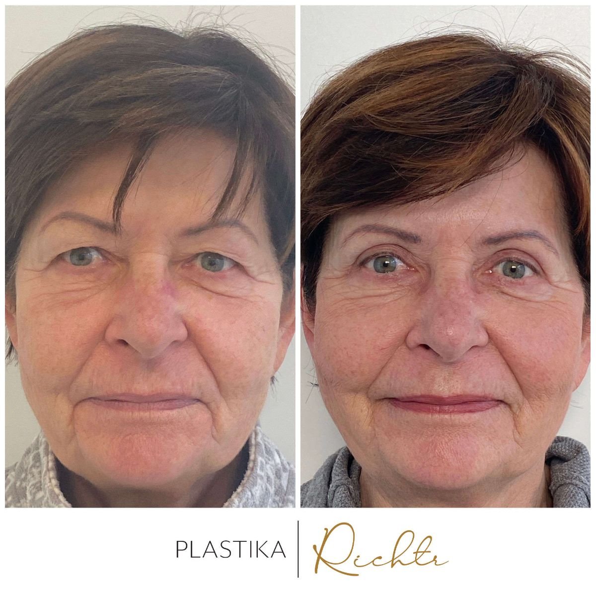 Resultados de blefaroplastia antes y después en Altoa | Czech Hospital of Horovice, corrección de párpados